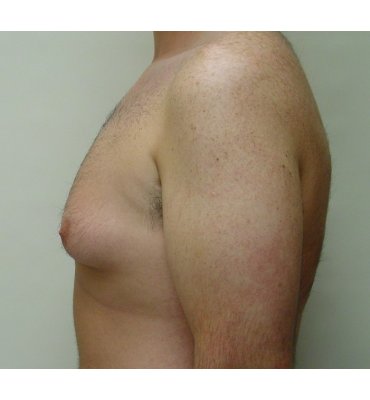 gynecomastio before